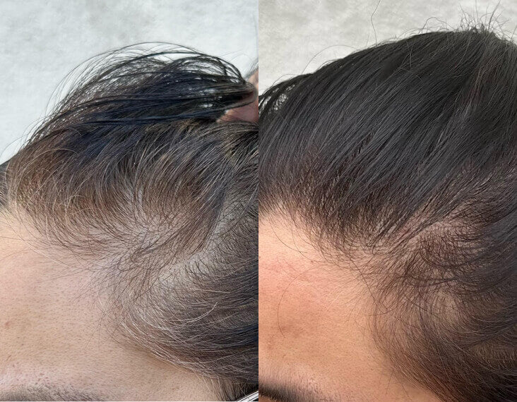 شامبو ثيكلي لتقوية الشعر - لطيف على الفروة الحساسة ويقلل التساقط